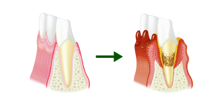 歯周病